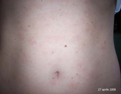 pytiriasis